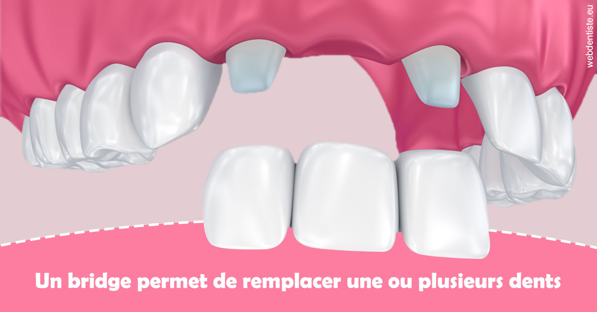 https://dr-yves-gozlan.chirurgiens-dentistes.fr/Bridge remplacer dents 2