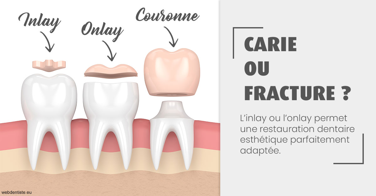 https://dr-yves-gozlan.chirurgiens-dentistes.fr/T2 2023 - Carie ou fracture 1