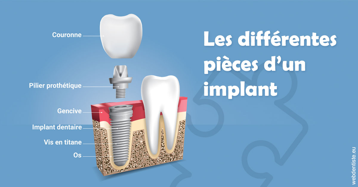 https://dr-yves-gozlan.chirurgiens-dentistes.fr/Les différentes pièces d’un implant 1